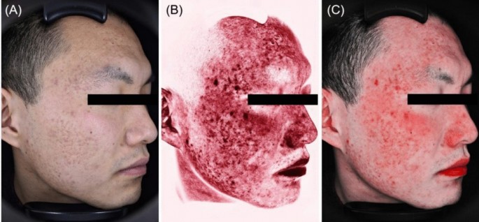 Reference image of a man photographed under different skin imaging modes