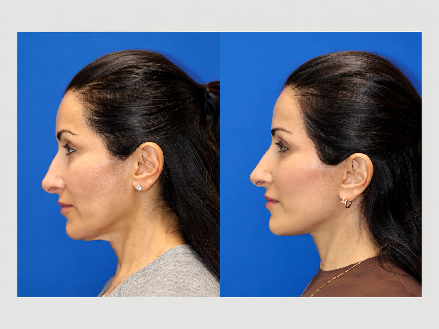 Facial profile comparison