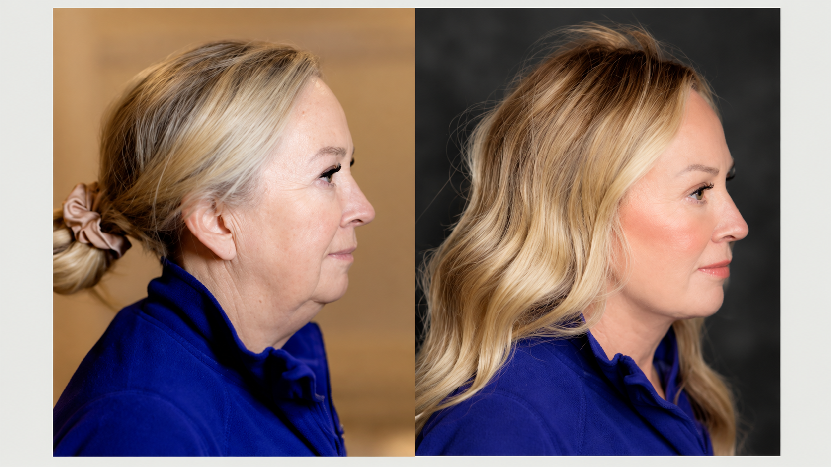 Jawline appearance comparison
