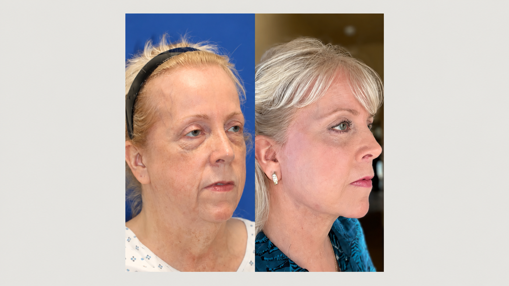Facial rejuvenation comparison