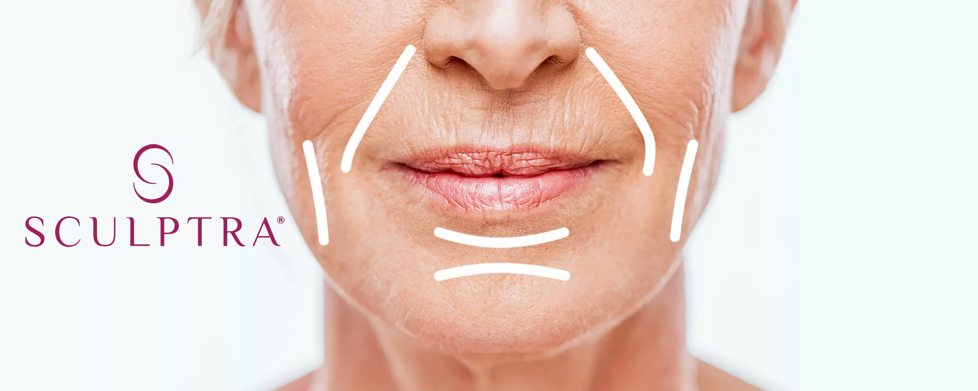 Sculptra collagen stimulation illustration